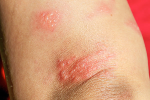 A gombás bőrbetegségek tünetei és kezelése